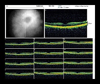 RADIAL LINE OD